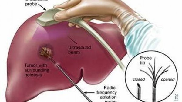 Liver-cancer-diagnosis