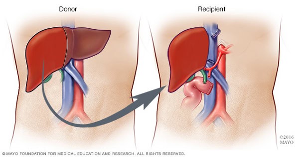 liver_transplantthu