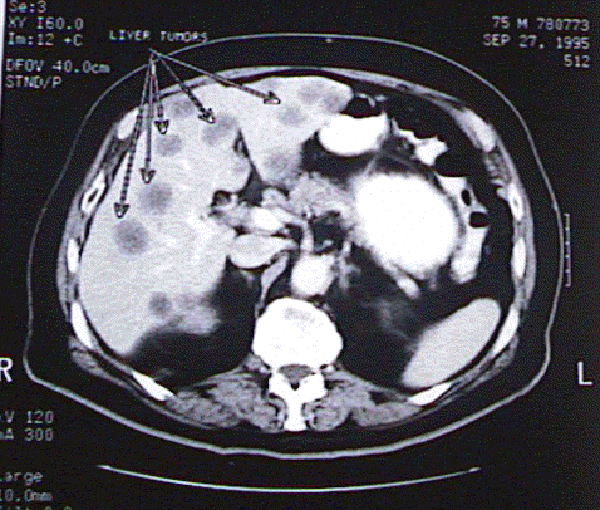 livertumors