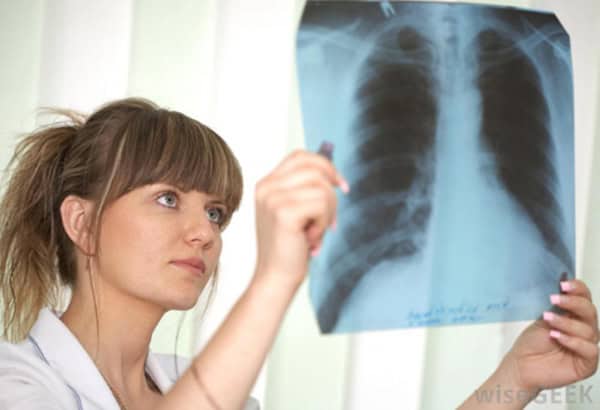pneumonia (d