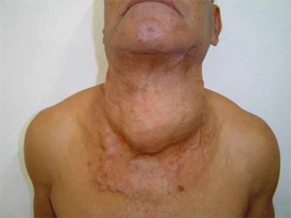 thyroid-cancer -s