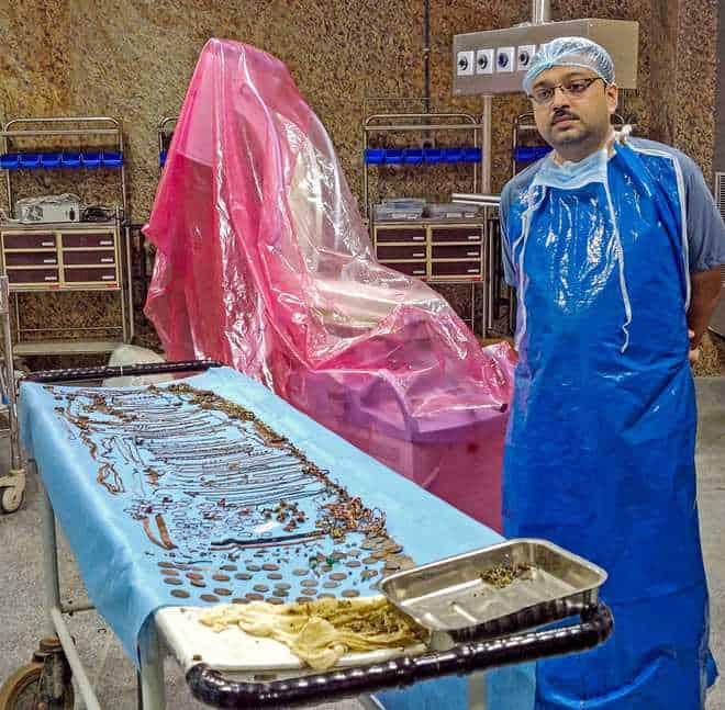 1.5kg of ornaments found in woman’s stomach