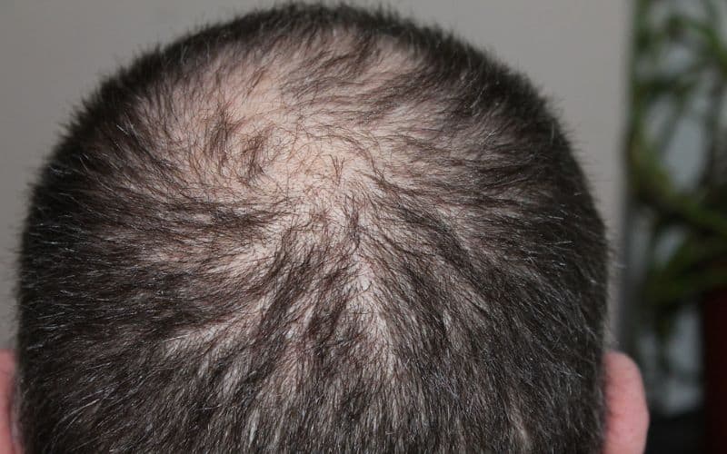 Air pollution may result in hair loss