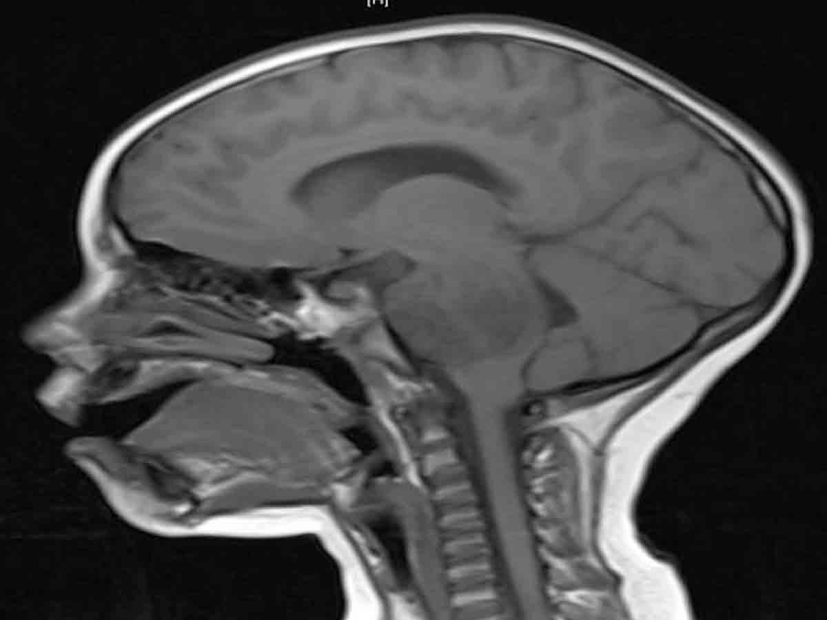 Doctors remove tumor from the brain of a 50-year-old