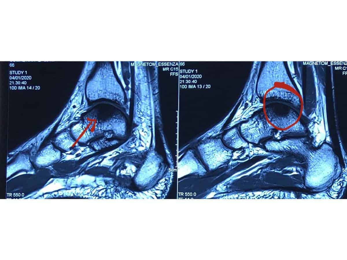 Fitness freaks may suffer minor injuries leading to major surgeries
