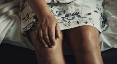 This bone drug may be beneficial for knee osteoarthritis