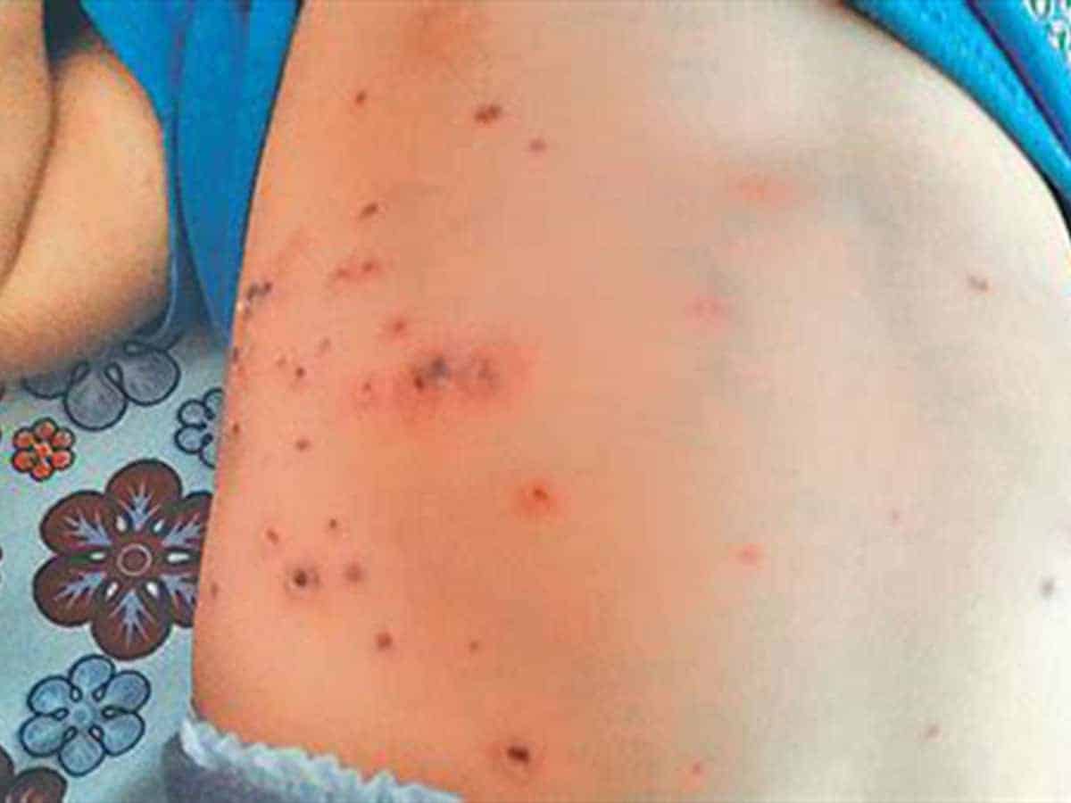 Scrub Typhus disease in Noklak district of NaScrub Typhus disease in Noklak district of Nagaland galand