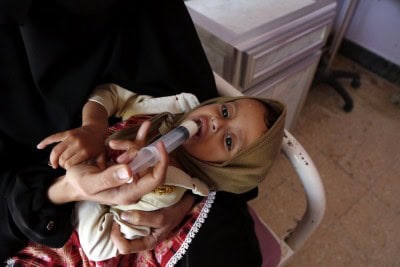 Over 10 mn children to suffer from acute malnutrition in 2021: Unicef