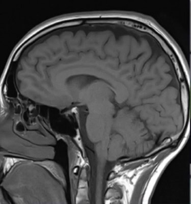 New drug-delivery system could treat brain disorders