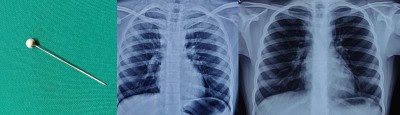 Covid fear helps detect metal pin in Mumbai girl's chest