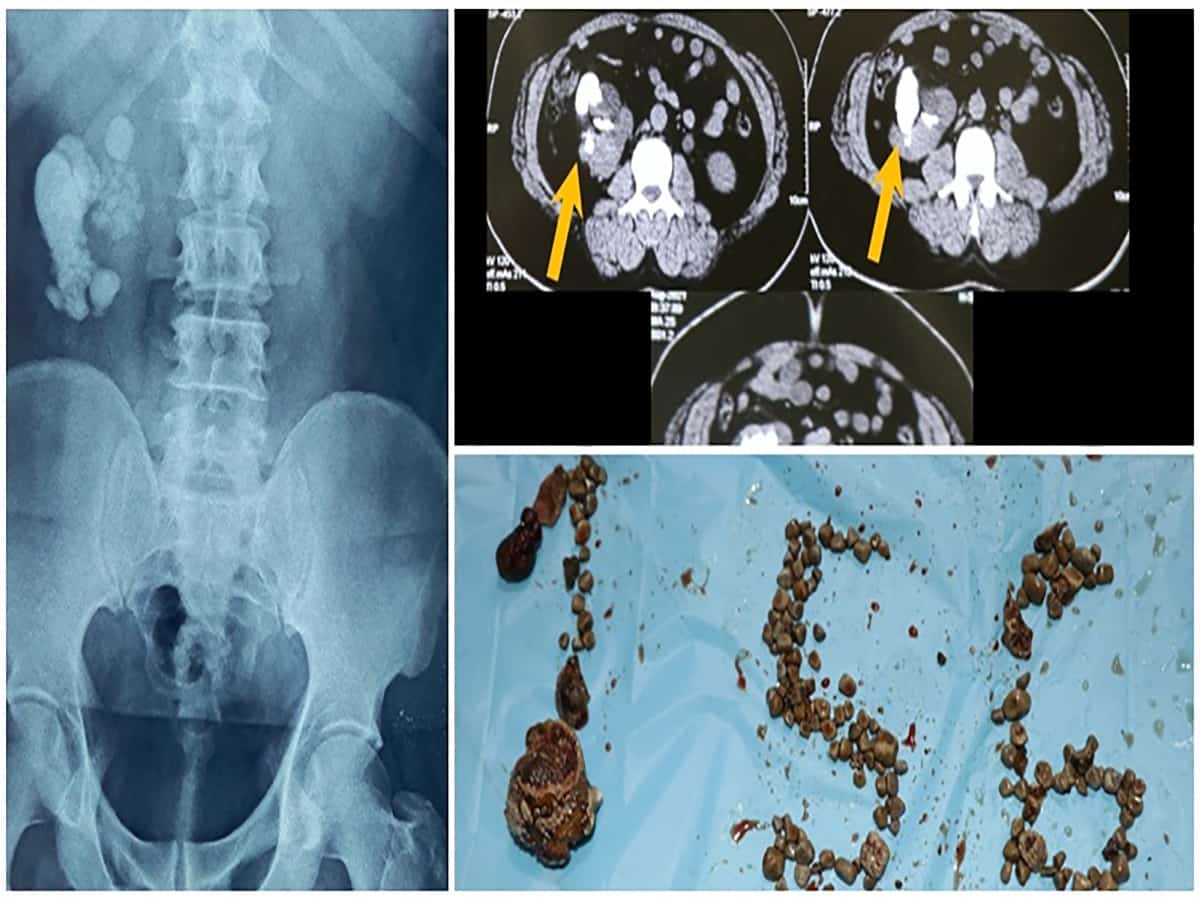Renal stones