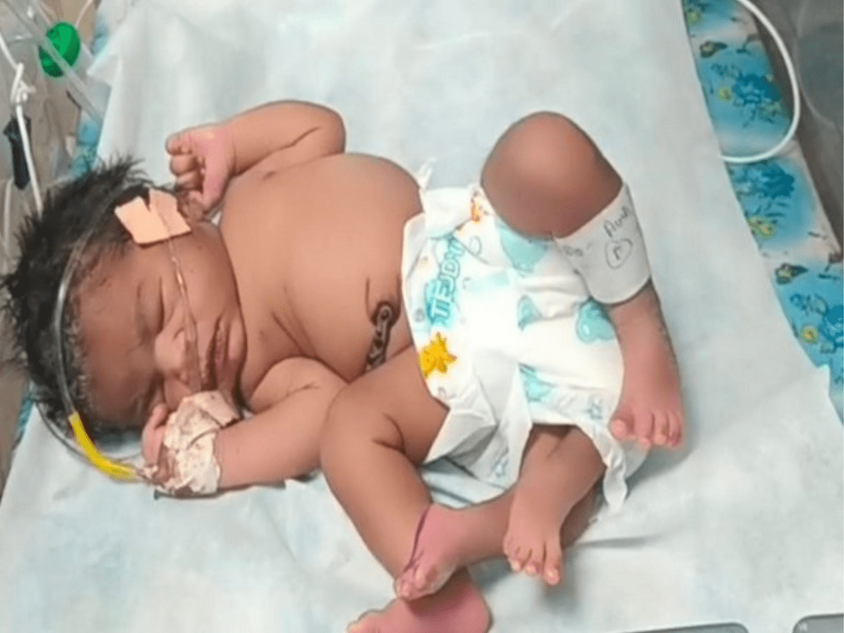 Woman gives birth to baby girl with 'four' legs in MP's Gwalior