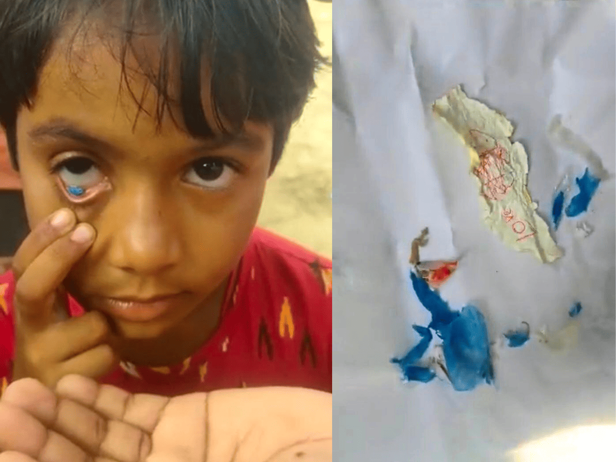 Plastic, paper coming out of girl's eye in Telangana's Mahbubabad